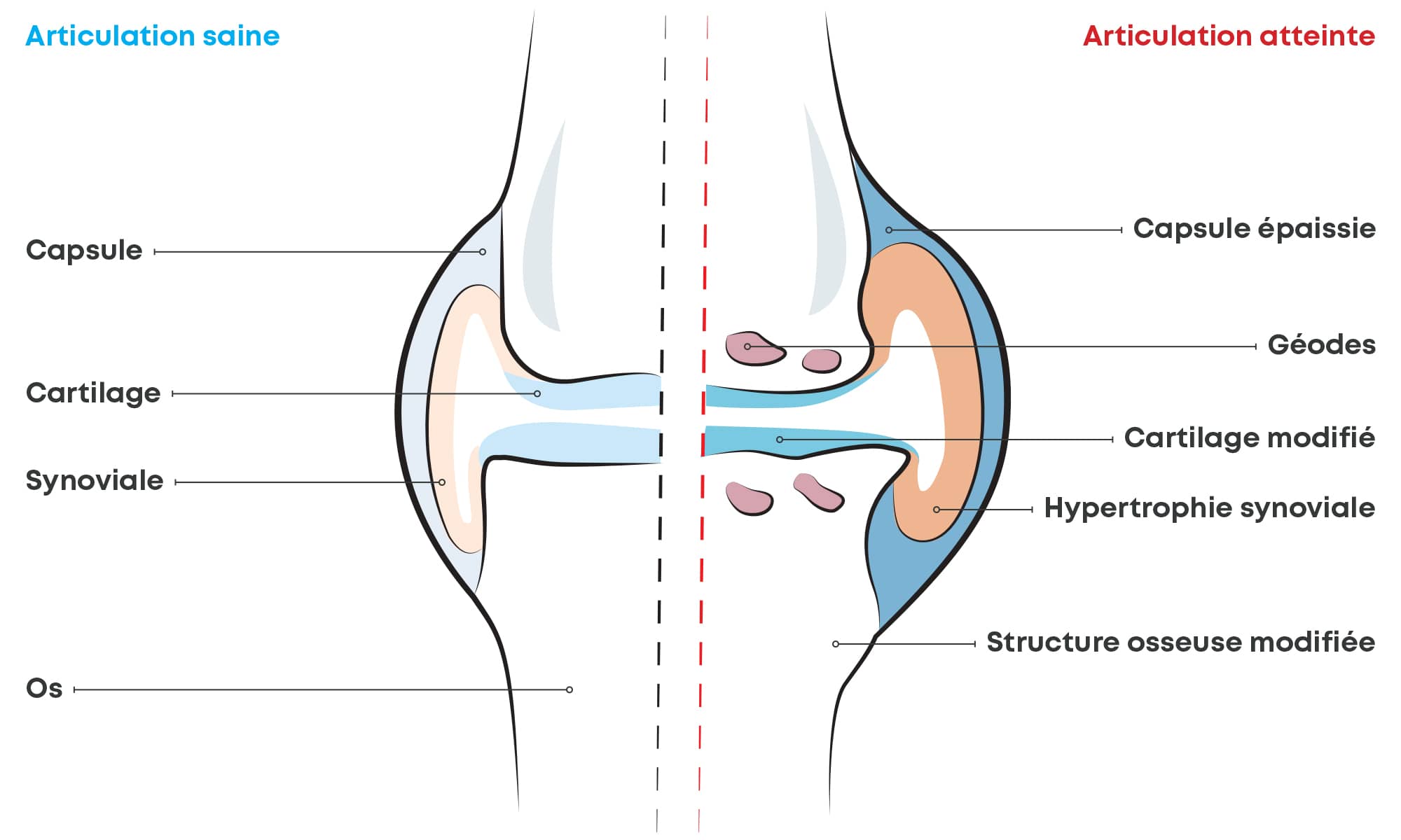 Schéma des conséquences de l'arthrose sur l'articulation - orliman
