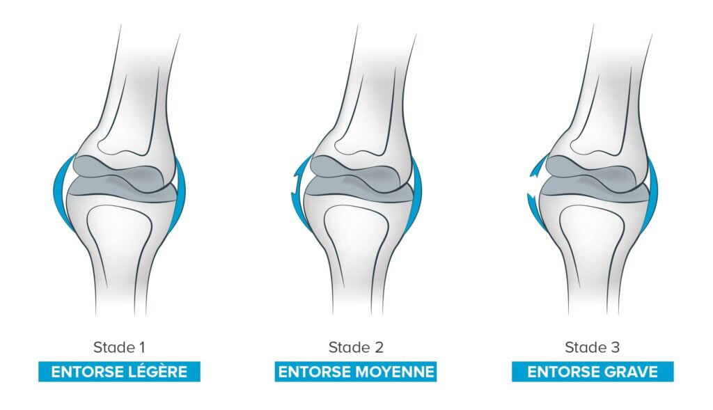 Entorse Causes, symptômes et traitements de l