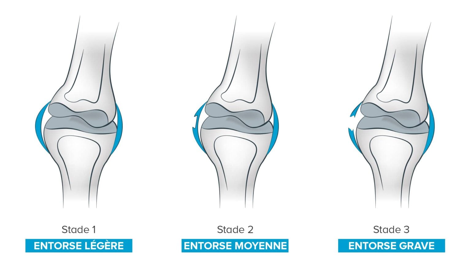 Entorse Causes, symptômes et traitements de l