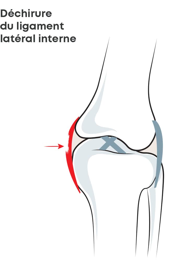 Schéma anatomique de l'entorse modérée du genou (stade 2) - orliman