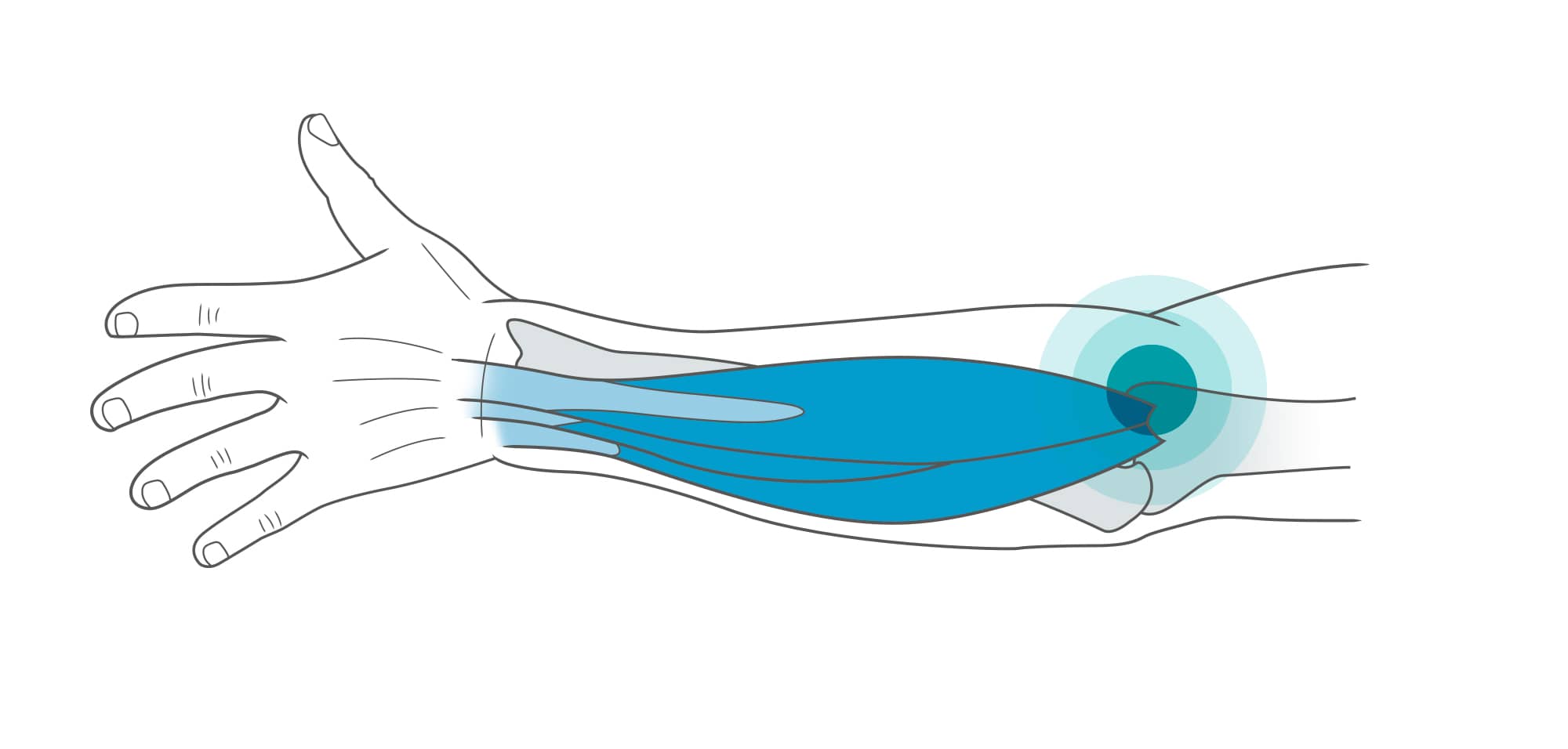 Illustration anatomique d'un avant-bras avec focus sur la zone de l'épicondylite