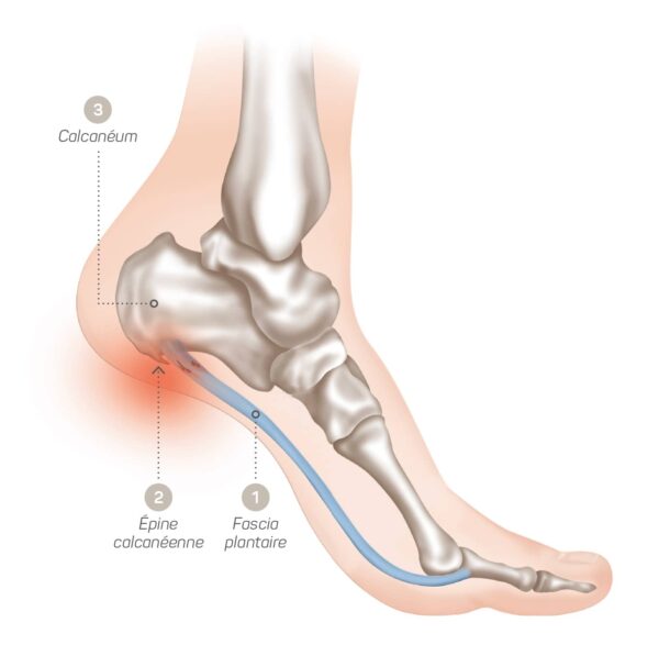Fasciite plantaire Comment la reconnaitre et la soigner Orliman
