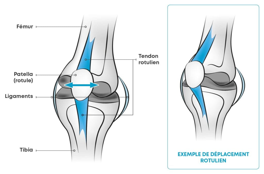 Instabilité rotulienne Causes, symptômes et traitements Orliman — free download