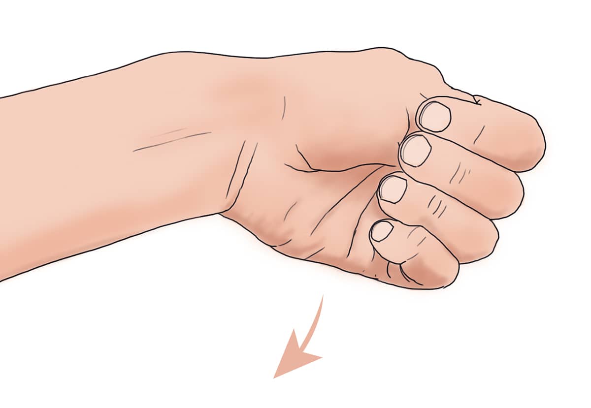 Illustration du test de Finkelstein pour diagnostiquer la tendinite de De Quervain au niveau du poignet