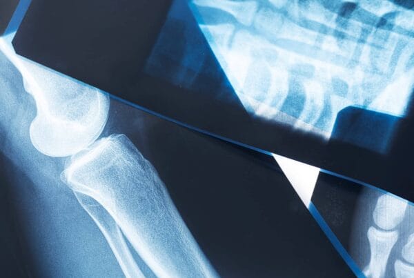 Radiographies montrant des os du membre inférieur, illustration utilisée pour expliquer la fracture de fatigue et son diagnostic